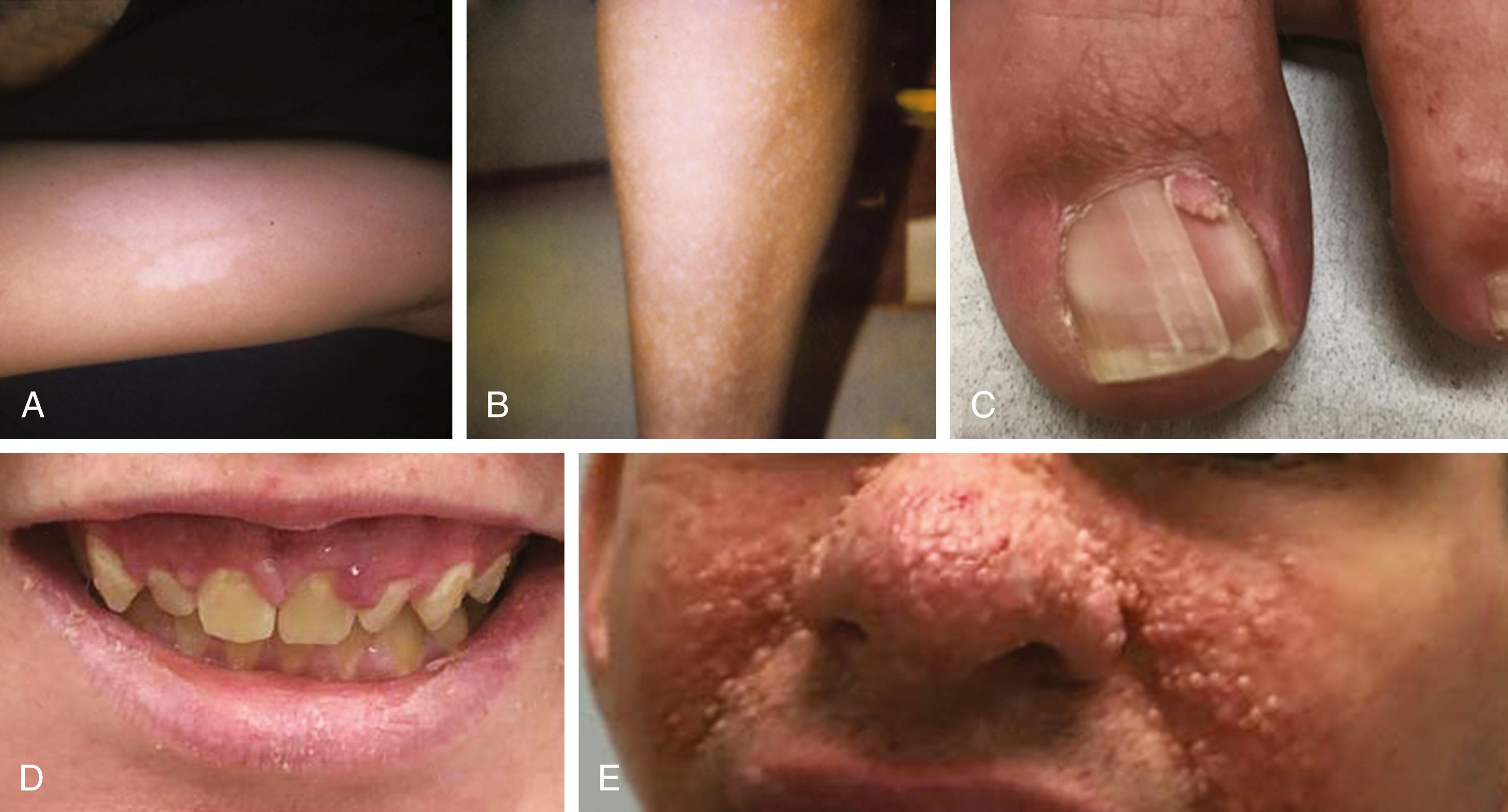 Fig. 17.1, Common cutaneous findings in patients with tuberous sclerosis including hypopigmented macule or Ash leaf spot (A), confetti lesions (B), ungual fibroma (C), gingival fibromas (D), and facial angiofibromas (E).