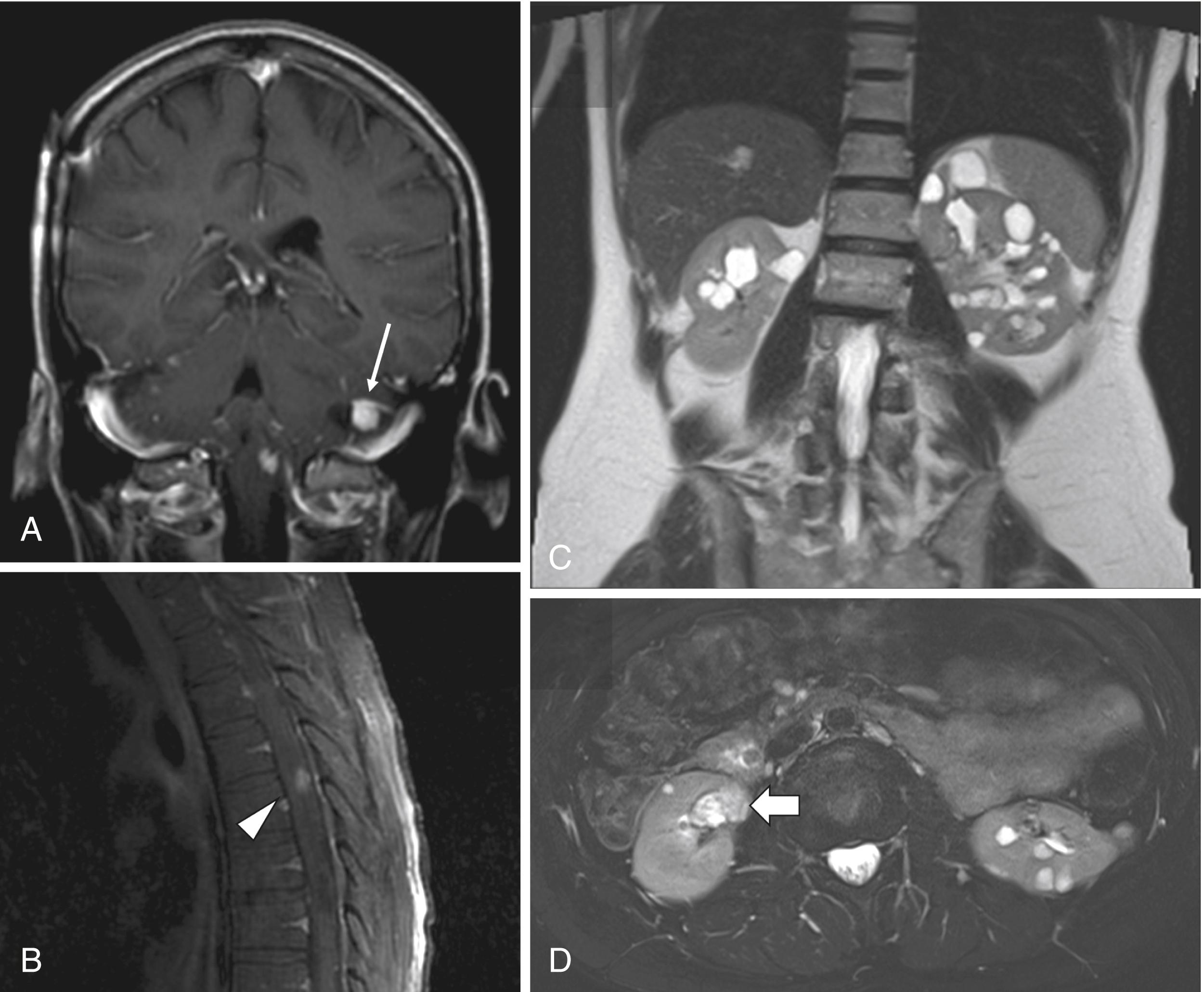 Fig. 18.1, Imaging findings in patients with von Hippel Lindau. (A) T1-weighted gadolinium enhanced MRI with several scattered homogeneously enhancing lesions with surrounding cyst (white arrow) consistent with a cyst with mural nodule lesion consistent with cerebellar hemangioblastoma alongside with an enhancing medullary lesion. (B) T1-weighted gadolinium enhanced MRI of the spine showing an enhancing thoracic spine lesion (arrowhead) consistent with a spinal cord hemangioblastoma. (C) T2-weighted MR of the kidneys showing numerous renal cysts; and (D) an irregular appearing lesion with bulbous outgrowth in the right upper renal pole (large white arrow) concerning for renal cell carcinoma that was subsequently ablated.