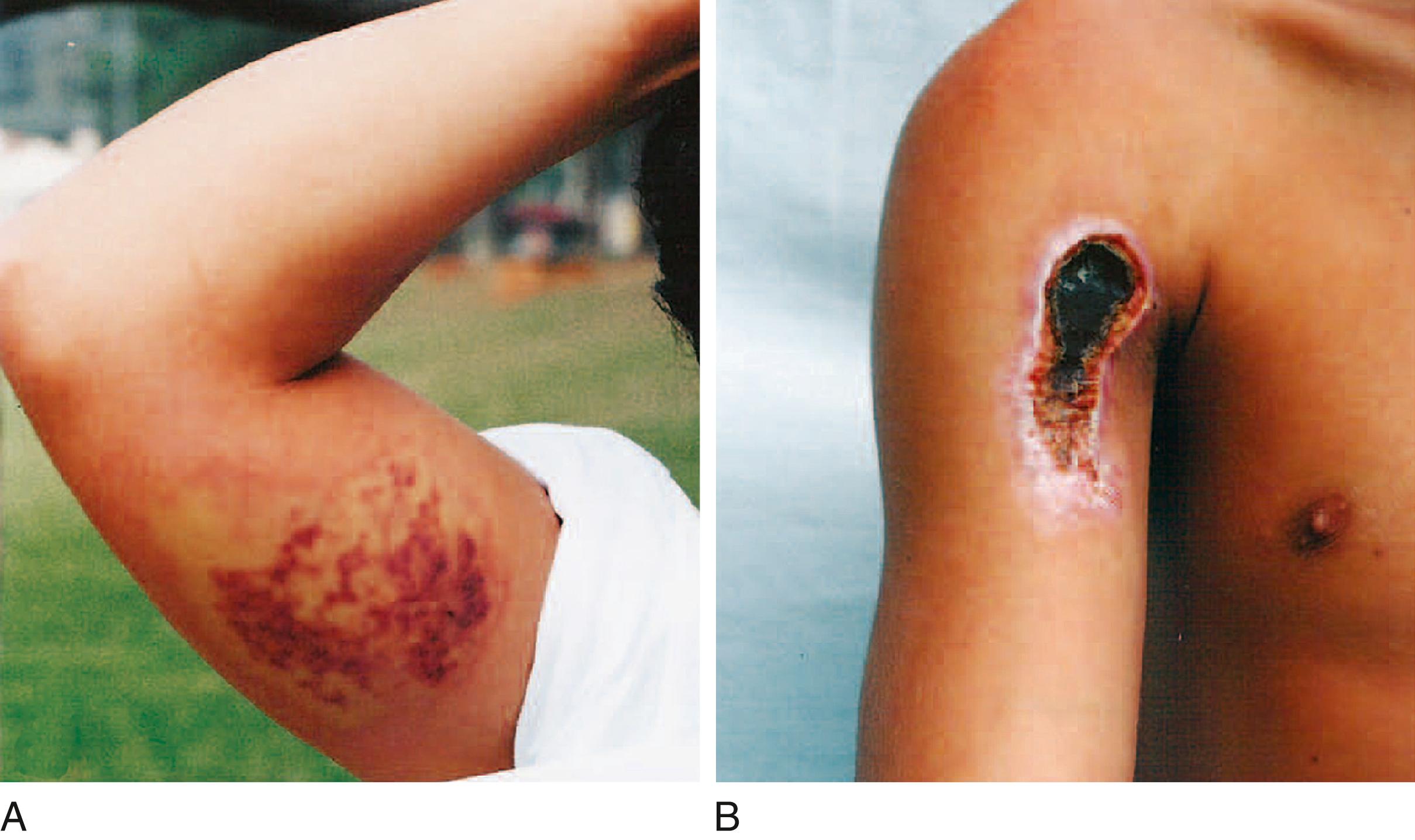 Fig. 163.1, Appearance of presumptive loxoscelism. (A) Local damage 48 hours after being bitten. (B) Another patient seeking medical care for necrotic scab 26 days after a suspected spider bite.