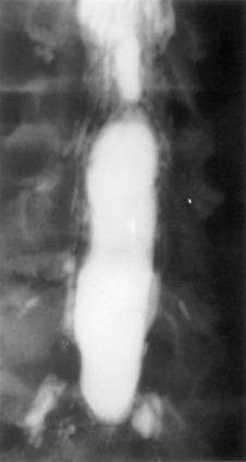 FIG. 106.1, Myelogram with oil-based medium demonstrating the marked lack of filling of nerve roots of adhesive arachnoiditis.