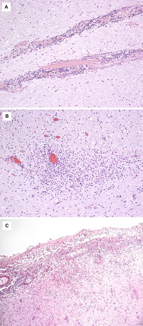 Figure 7-1, Acute viral encephalitis usually shows inflammatory cells infiltration in the (A) perivascular space, (B) parenchyma, and (C) leptomeninges. H&E stain, A and B, 100 × original magnification; C, 50 × original magnification.