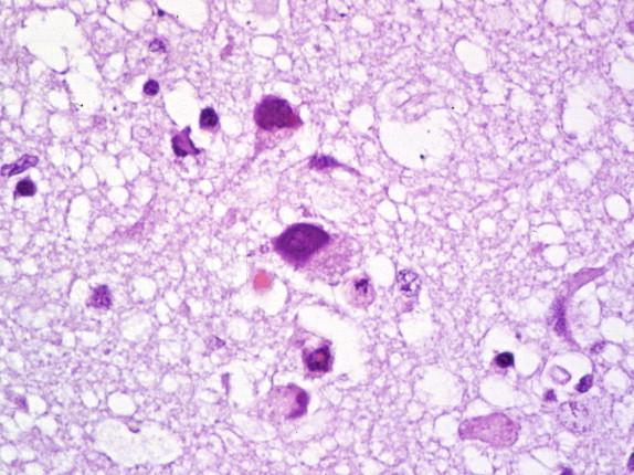Figure 7-11, Smudge cells with intranuclear inclusions in adenovirus encephalitis. H&E stain, 200 × original magnification.