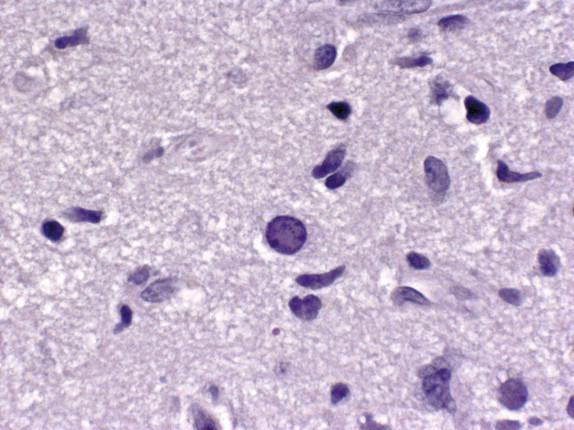 Figure 7-12, Intranuclear inclusions in progressive multifocal leukoencephalitis with JC polyomavirus infection. H&E stain, 200 × original magnification.