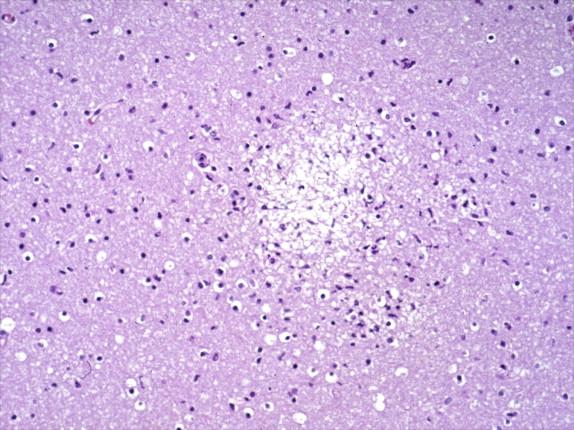 Figure 7-14, Liquefactive parenchymal necrosis in the brain of a fatal EEE case. H&E stain, 100 × original magnification.