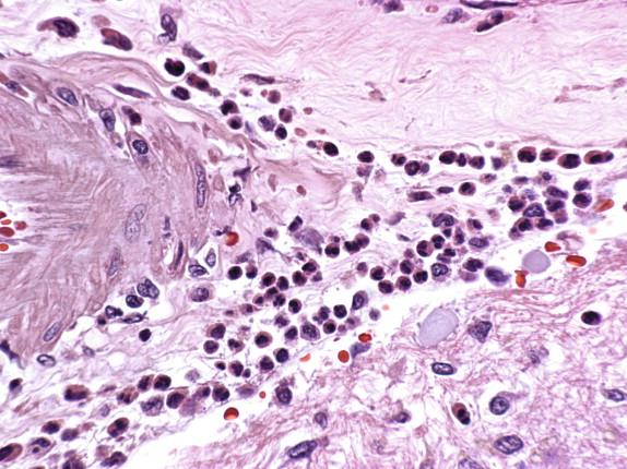 Figure 7-15, Perivascular cuffing with prominent polymorphonuclear and mononuclear leukocytes in the brain of a fatal EEE case. H&E stain, 400 × original magnification.