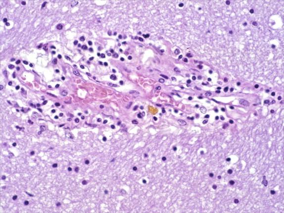 Figure 7-16, Vasculitis with vessel occlusion, perivascular extravasation of red blood cells, and endothelial cell swelling in the brain of a fatal EEE case. H&E stain, 200 × original magnification.