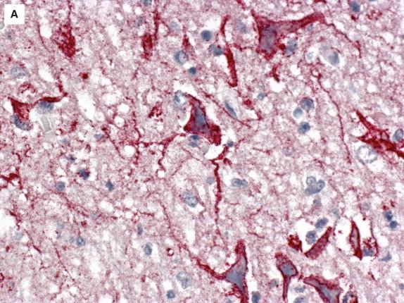 Figure 7-18, EEE viral antigens are demonstrated by IHC staining in neurons (A) , neuronal processes (A) , and areas of parenchymal necrosis (B) . IHC, A, 400 × original magnification; B, 100 × original magnification.