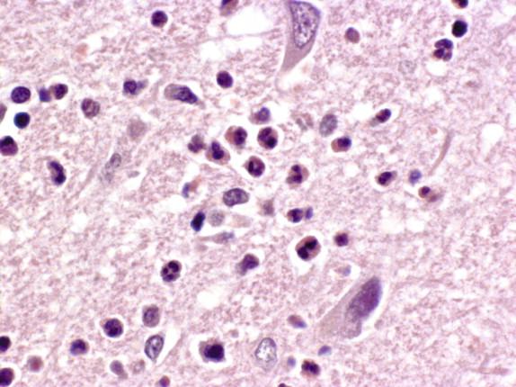 Figure 7-2, The degree and type of inflammation varies in cases of viral encephalitis; typically lymphocytes predominate, but some viral infections may be associated with more abundant polymorphonuclear cells, as shown in this image, especially during the acute phase of infection. H&E, 400 × original magnification.