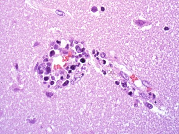 Figure 7-3, Vascular involvement with inflammatory cells can be seen in some viral infections, such as the Nipah virus, as seen in this image. H&E stain, 400 × original magnification.