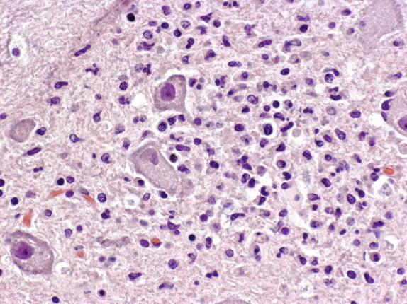 Figure 7-4, Neuronophagia; infected neurons are surrounded and phagocytized by inflammatory cells. H&E stain, 400 × original magnification.