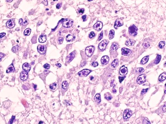 Figure 7-8, Cowdry type A inclusions in human herpes simplex encephalitis. H&E stain, 400 × original magnification.