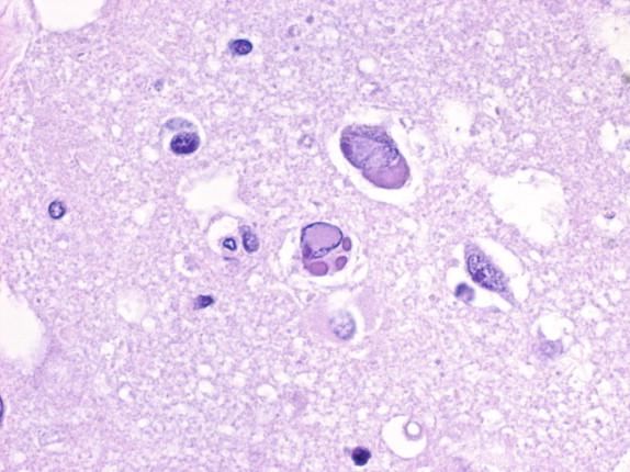 Figure 7-9, Intranuclear and intracytoplasmic inclusions in measles encephalitis. H&E stain, 200 × original magnification.