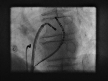 Figure 21.1, X-ray fluoroscopy image (left anterior oblique) showing the catheters during ablation of an accessory pathway at the left lateral aspect of the mitral valve annulus.