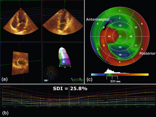 Figure 21.2, Patient example of mechanical dyssynchrony using transthoracic three-dimensional echocardiography (3DE). After acquisition of an apical 3DE dataset (full volume), designated software allows quantification of global and regional function (a). A regional time to minimal systolic volume (Tmsv) curve can be generated for all segments (b) that can be shown as a polar plot (c). The systolic dyssynchrony index (SDI) is a measure of mechanical dyssynchrony and expressed as the standard deviation of the Tmsv of all segments and as a percentage of the cardiac cycle (in this case 25.8%; normal 1.3 ± 0.5%).