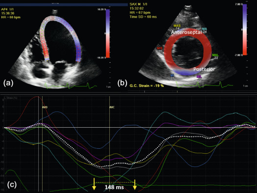 Figure 21.3, Speckle tracking echocardiography (STE). Patient example of STE analysis of apical four-chamber view (a) and mid-ventricular short-axis (b) for measuring longitudinal and radial strain, respectively. Specifically designed software measures the movement of natural acoustic markers (speckles) during the cardiac cycle. (c) A time difference between the anteroseptal and posterior wall segmental peak systolic strain of 148 ms (arrows) was found (≥ 130 ms is considered significant dyssynchrony).