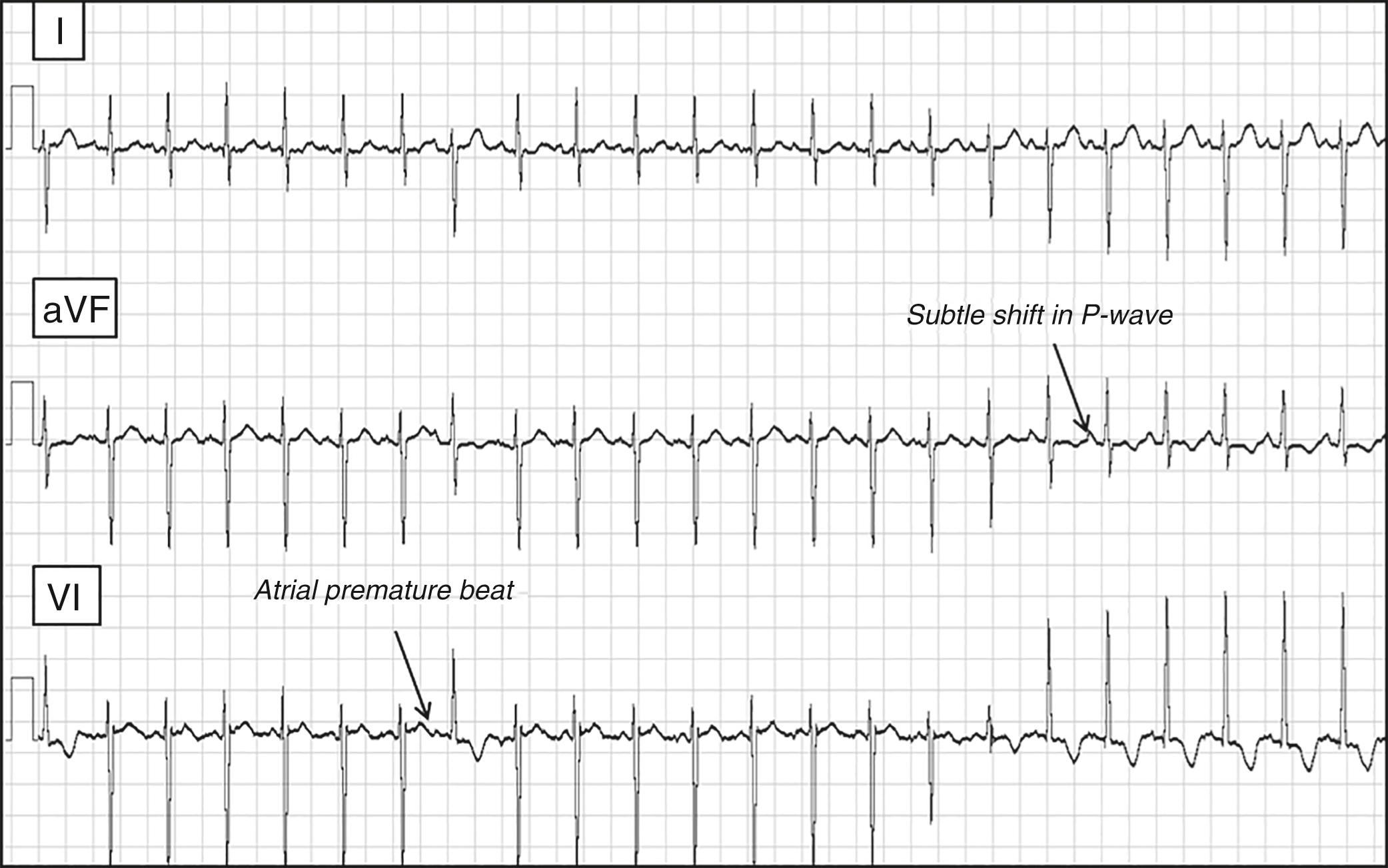 Fig. 114.1, Three-lead rhythm strip (leads I, aVF, V 1 ) from an infant with heterotaxy of the asplenia type (right atrial isomerism) and twin atrioventricular (AV) nodes.