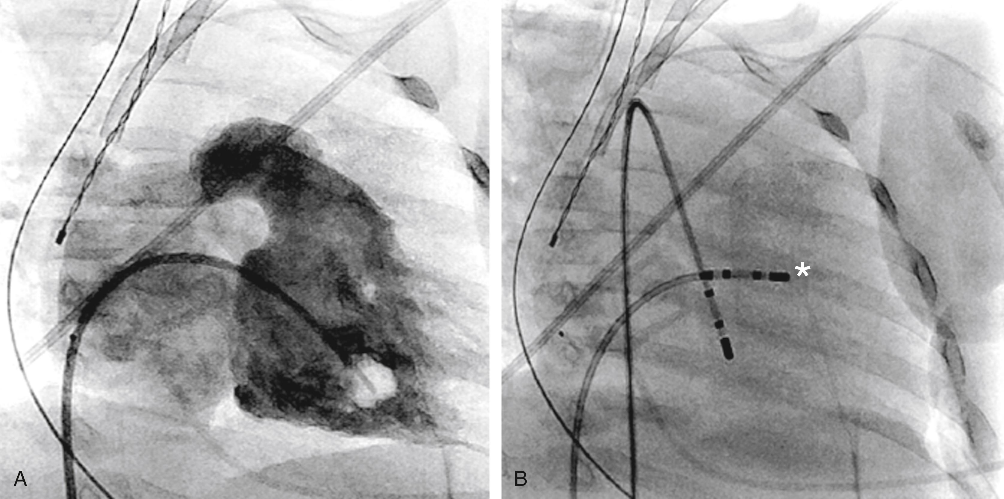 Fig. 114.2, Ablation in a 6-month-old child with incessant ventricular tachycardia (VT) arising near the proximal right bundle branch, leading to cardiomyopathy.