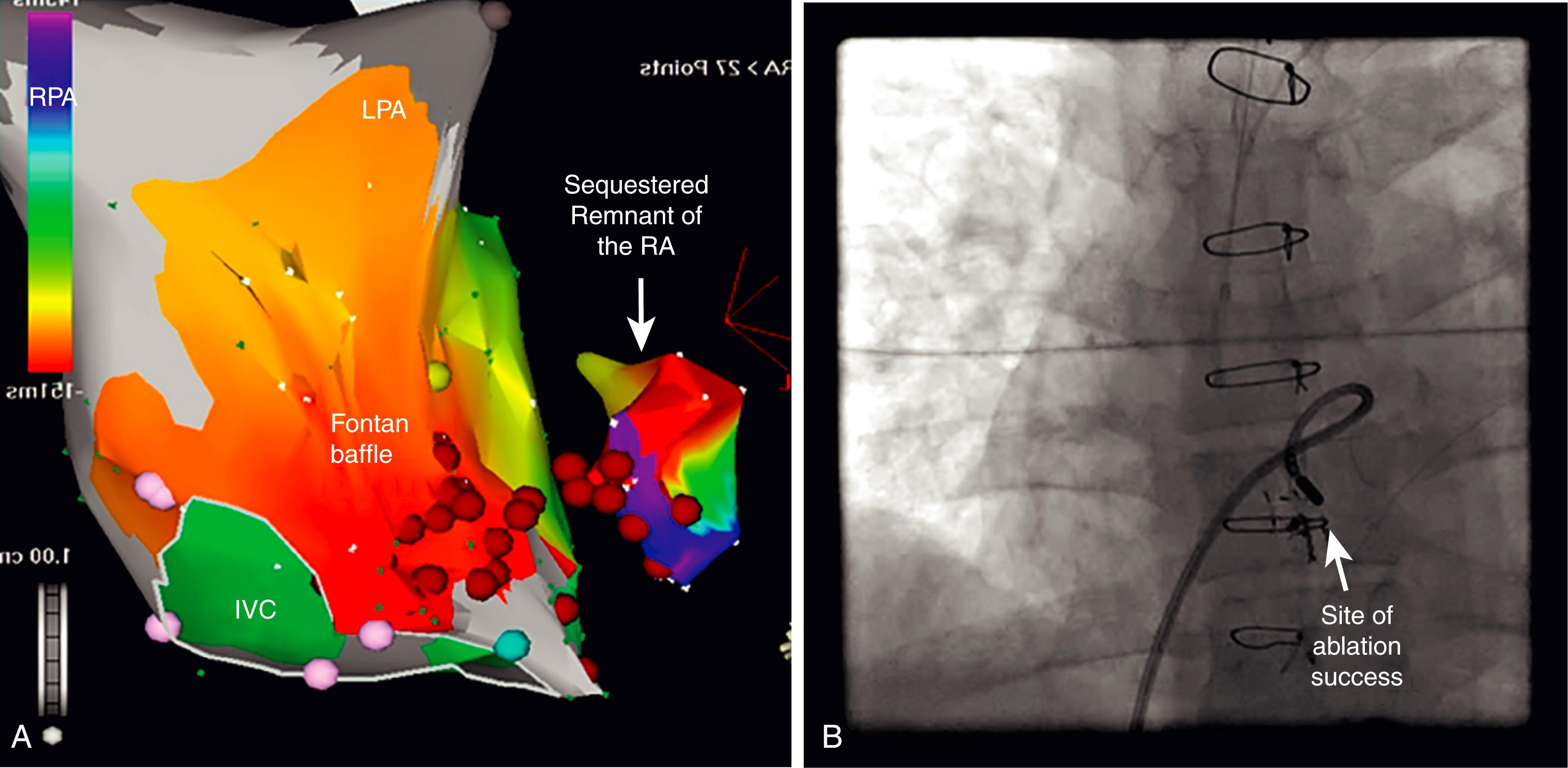 Fig. 114.3, Ablation of intraatrial reentrant tachycardia in distorted anatomy because of congenital heart disease.