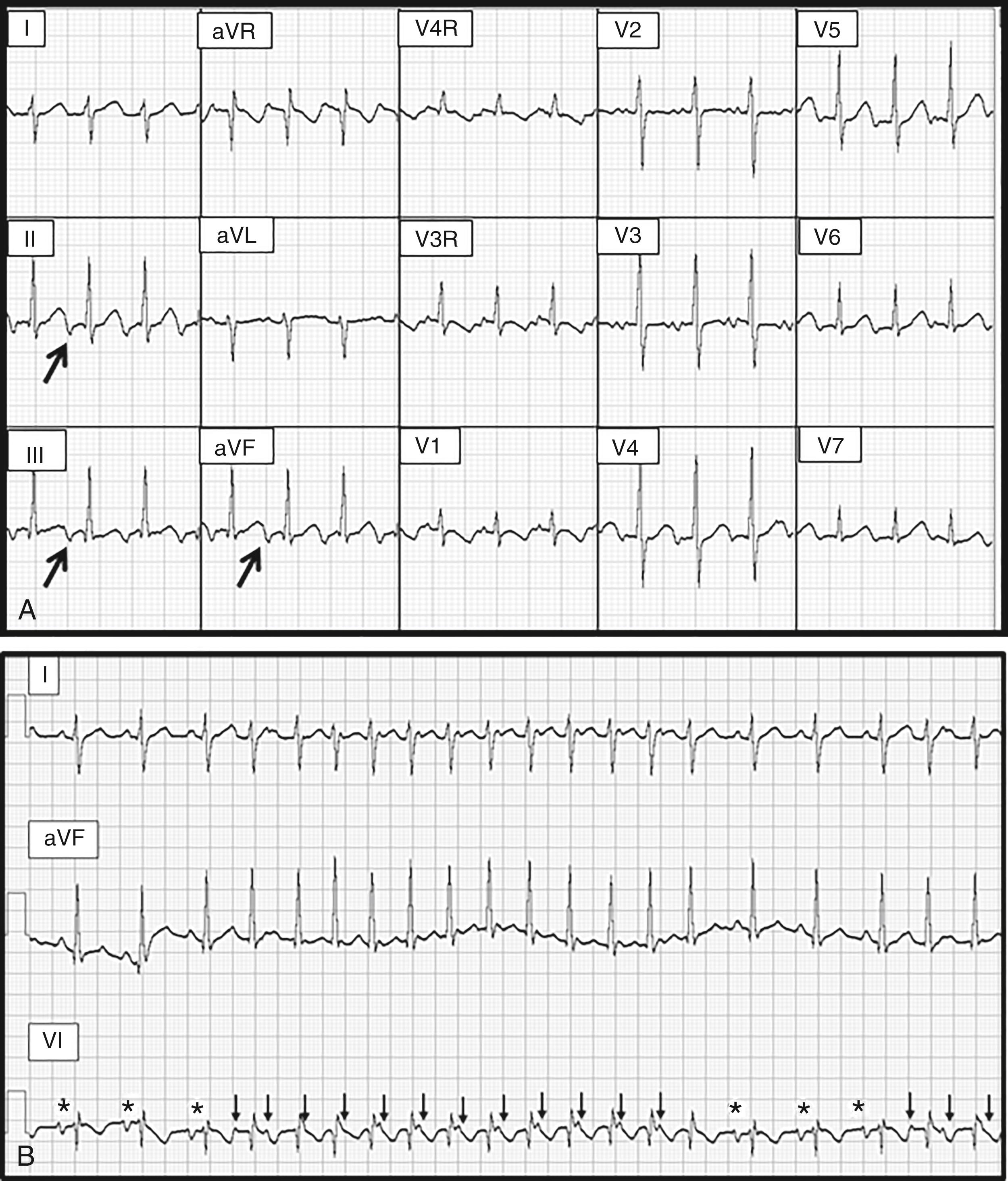 Fig. 114.5, Two common causes of tachycardia-induced myopathy in children.