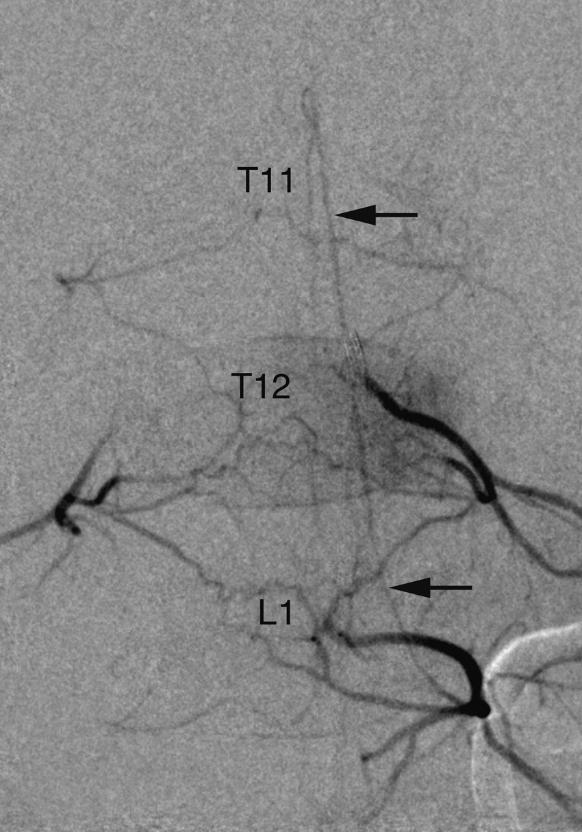 Fig. 57.11, Retrocorporeal network in a 3-year-old boy. Left T12 injection shows diamond-shaped retrocorporeal network over three levels (T11, T12, L1). A prominent posterior spinal contributor originating from left L1 ( arrows ) is opacified through the network. Visibility of retrocorporeal network decreases with age, so dangerous connections must always be looked for during spinal embolization.