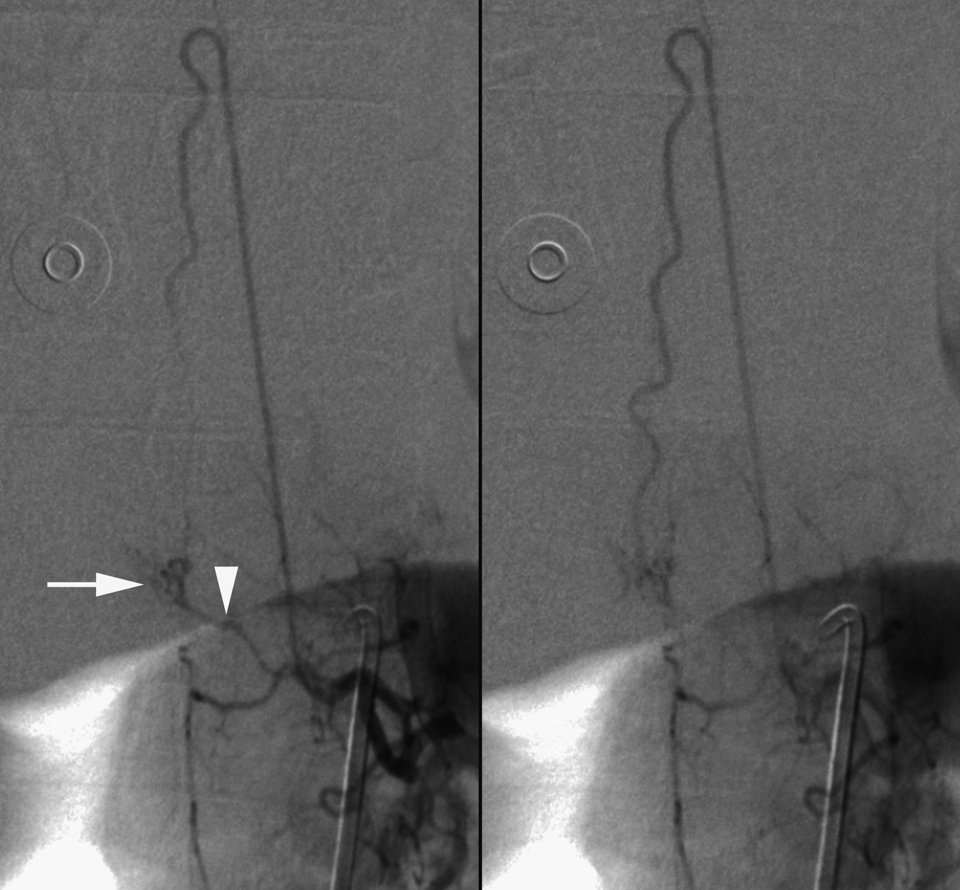 Fig. 57.12, Prominent cluster of posteromedian osseous branches. In early arterial phase ( left ), retrocorporeal artery ( arrowhead ) and its associated cluster of posteromedian osseous branches ( arrow ) are easily identified. Later in arterial phase ( right ), median capillary blush falsely appears to be connected with anterior spinal artery, and retrocorporeal artery is no longer visible. Location of blush, which projects over basivertebral foramen, provides a useful clue regarding its nature.