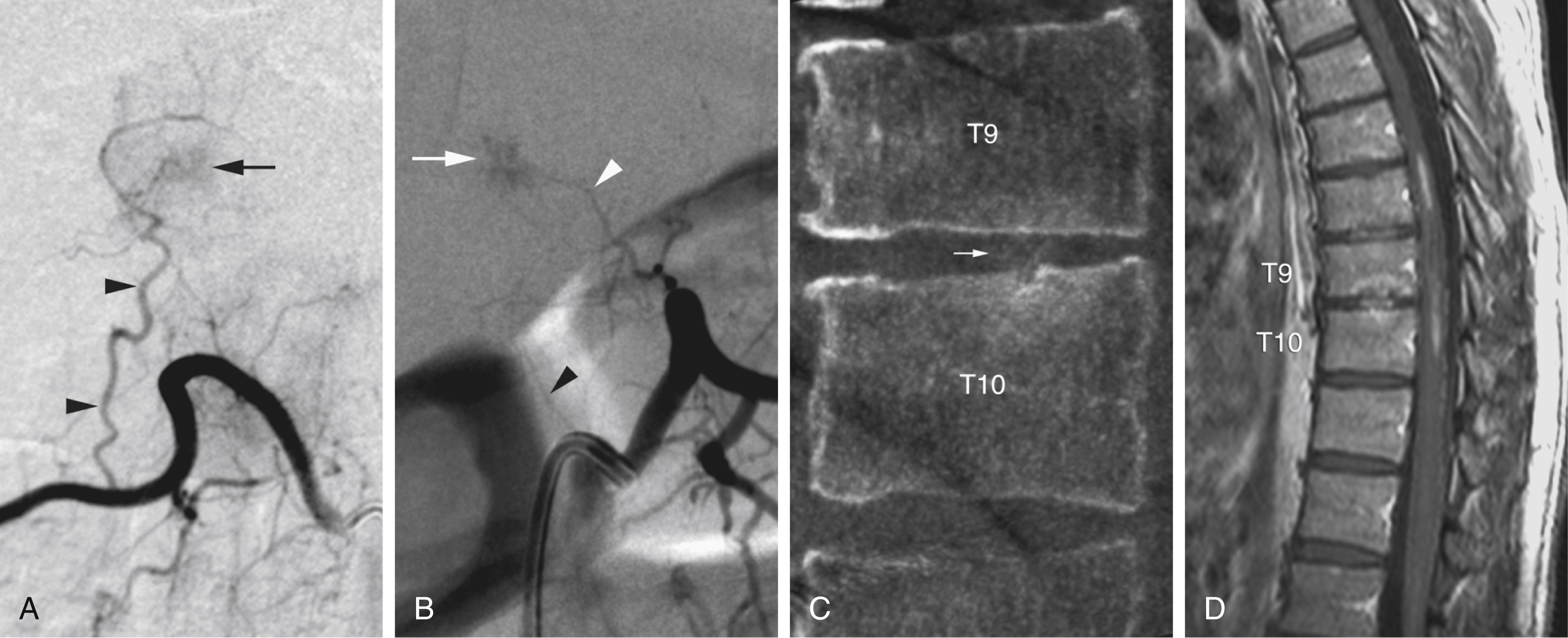 Fig. 57.13, Abnormal vertebral blushes. (A) Right L1 angiogram in patient with renal cell carcinoma. Paravertebral longitudinal anastomosis ( arrowheads ) opacifies metastatic lesion in lower aspect of T12 ( arrow ). (B) Similar image obtained during left T10 injection in patient with spinal cord hemorrhage. Here, abnormal blush ( arrow ) is opacified by superior osseous branch from internal segmental artery stem ( white arrowhead ) and corresponds to a Schmorl node. (C) Left T10 flat-panel catheter angiotomography confirms location of blush within T9–T10 intervertebral space ( small arrow ), correlating with a Schmorl node, documented by magnetic resonance imaging (D). Blush can be distinguished from normal cluster of posteromedian osseous branches by its location (away from basivertebral foramen) and by its feeding artery, distinct from retrocorporeal artery.