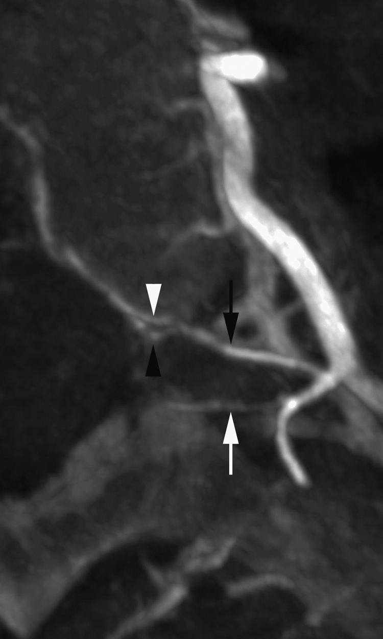 Fig. 57.14, Spinal canal arteries, including prelaminar artery. Common configuration of the three spinal canal arteries is shown in this axial reconstruction of a selective thoracic flat-panel catheter angiotomogram. Black arrow points at an anterior trunk (spinal branch of internal segmental artery [ISA]) dividing into retrocorporeal artery (or anterior spinal canal branch) ( white arrowhead ) and radicular artery (or intermediate spinal canal branch), which gives a prominent anterior spinal artery contributor ( black arrowhead ). White arrow identifies prelaminar artery, or posterior spinal canal branch, arising separately from dorsal branch of ISA.