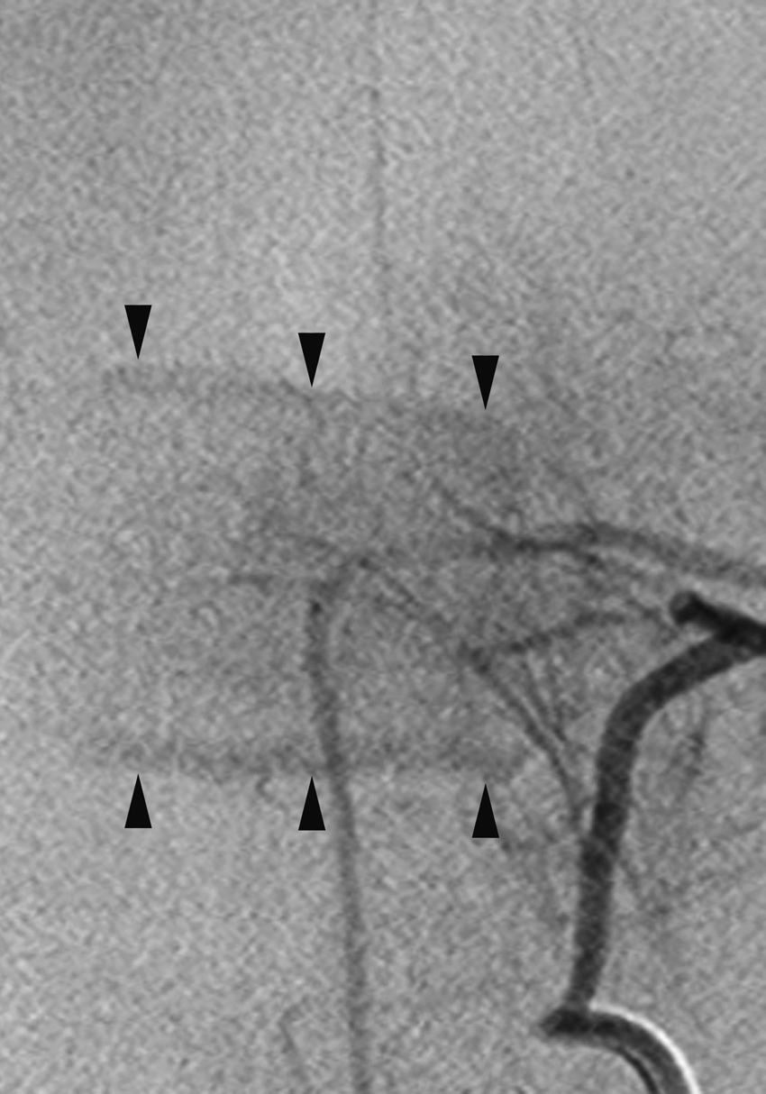 Fig. 57.15, Prominent endplate blush ( arrowheads ) seen in this left T6 angiogram in an 8-year-old boy is typical for children and should not be interpreted as an abnormal finding.