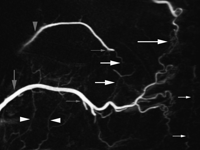 Fig. 57.16, Principal paravertebral arterial anastomotic pathways. Sagittal reconstruction of three-dimensional digital subtraction angiography of left L1 ( gray arrow ) illustrates several paravertebral anastomotic pathways. Ascending and descending osseous branches of internal segmental artery stem are documented; two of them establish anterior laterovertebral anastomoses with ascending branches of L2 ( white arrowheads ). Stem of T12 ( gray arrowhead ) is opacified via posterior laterovertebral anastomosis ( short white arrows ). Dorsal muscular arteries of L1 form retrovertebral anastomotic network with corresponding branches from T11 ( long white arrow ). Small gray arrows designate radicular arteries of T12 and L1; small white arrow points at cutaneous network of L1.