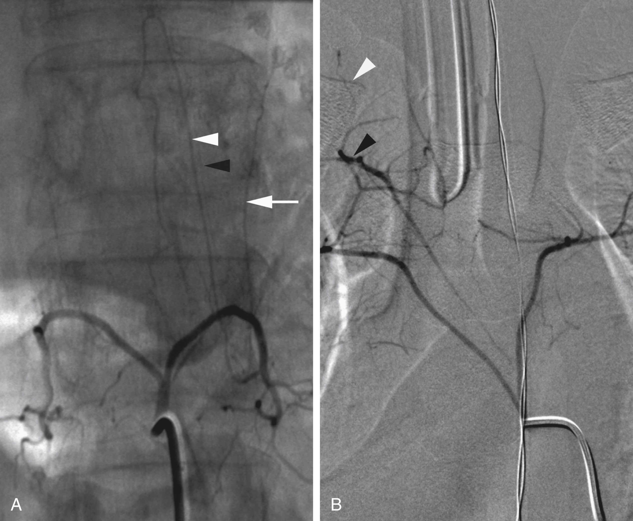 Fig. 57.17, Bilateral internal segmental artery trunks. (A) A common trunk for left and right L1. Left L1 provides prominent anterior ( white arrowhead ) and posterior ( black arrowhead ) spinal contributors, as well as adrenal branch ( white arrow ). (B) A common trunk for left and right T4. In this 12-year-old girl, common trunks for T6 and T7 were observed as well. Note collateral opacification of right T3 ( black arrowhead ) and T2 ( white arrowhead ).