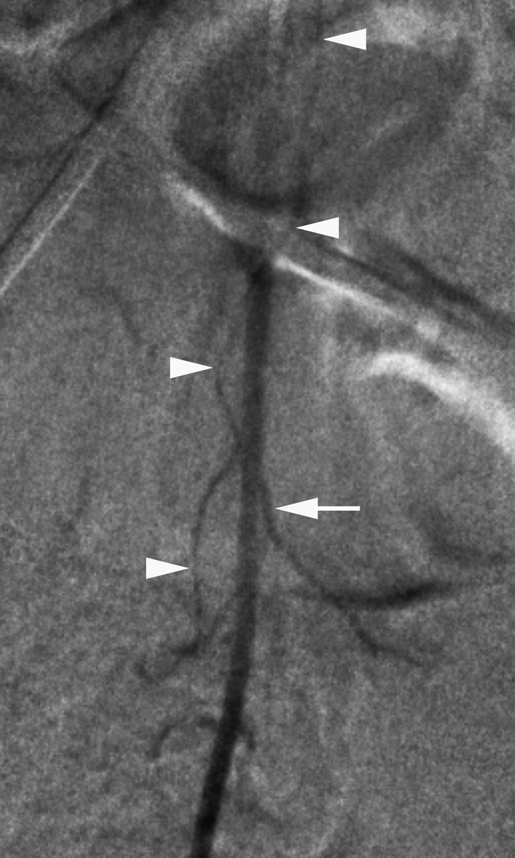 Fig. 57.18, Bilateral S1 trunk from the median sacral artery (MSA). The trunk includes a short common stem ( arrow ), separate from the MSA itself, which divides into left and right S1 branches. Note a prominent anterior spinal artery contributor from right S1 ( arrowheads ). Compare with Fig. 57.5B , in which normal L4 and L5 internal segmental arteries arise separately from the MSA.