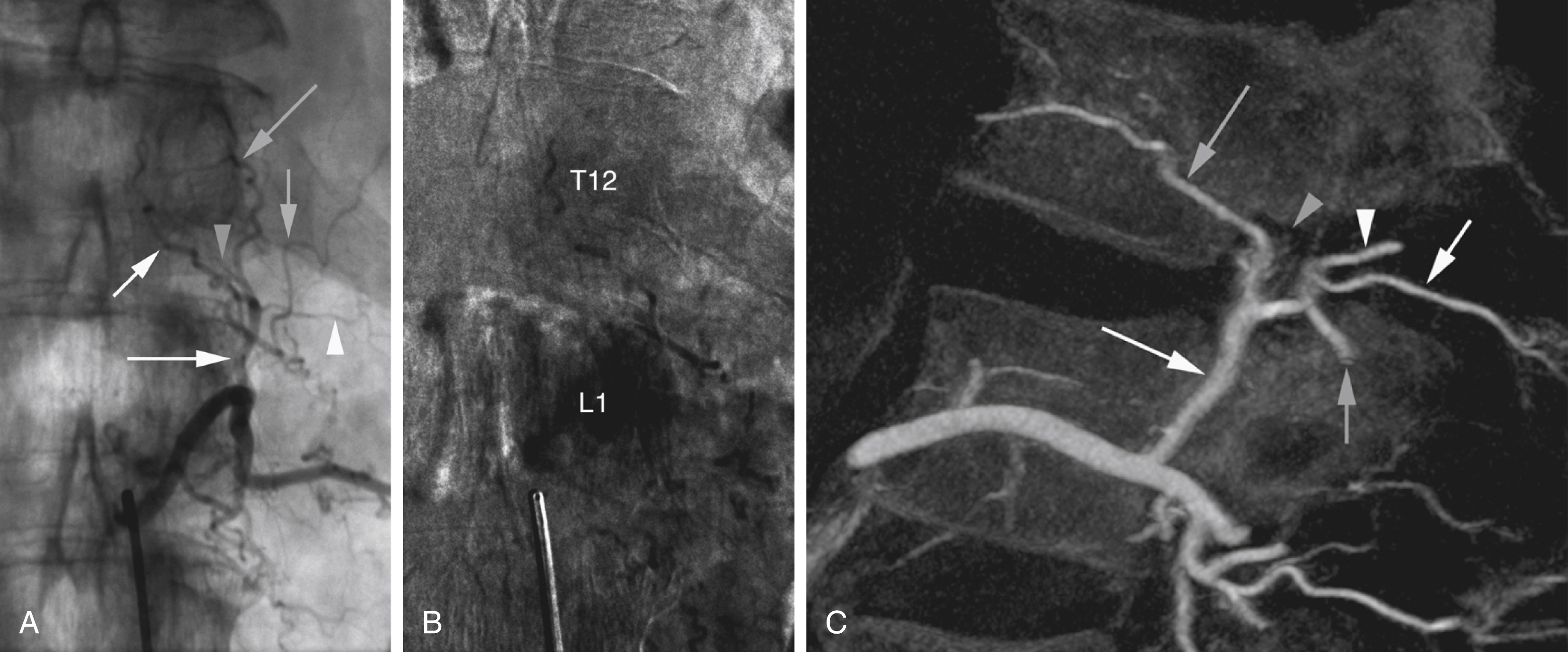 Fig. 57.19, Complete ipsilateral trunk for L1 and T12. (A) Left L1 injection, with concomitant opacification of various structures at T12: branch running anteriorly along lateral aspect of T12 vertebral body ( long gray arrow ), corresponding to left T12 stem; left T12 dorsal branch with its musculocutaneous arteries ( short white arrow ); left T12 spinal branch ( gray arrowhead ); and small lateral branch (i.e., left subcostal artery) ( white arrowhead ). These branches form a complete left T12 internal segmental artery (ISA), opacified via robust posterior laterovertebral anastomosis ( long white arrow ) that continues as inferior phrenic artery ( short gray arrow ). (B) Capillary phase of injection, with parameters set to emphasize complete hemivertebral blushes at L1 and T12. (C) Sagittal flat-panel catheter angiotomography reconstruction confirms presence of complete T12 ISA, with its four components: stem ( long gray arrow ), spinal branch ( gray arrowhead ), dorsal branch ( short white arrow ), and lateral branch ( white arrowhead ), opacified by posterior laterovertebral anastomosis ( long white arrow ).