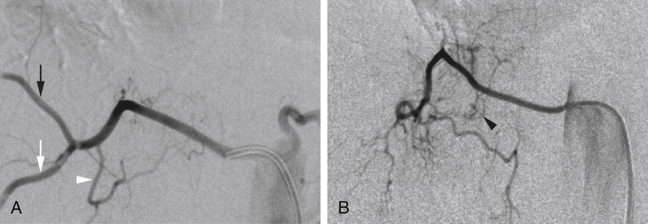 Fig. 57.20, Incomplete ipsilateral trunk with isolated dorsispinal artery (DA) at right T10. (A) Ipsilateral trunk for right T11 and T10, which includes lateral branches for both T10 and T11 ( white and black arrows ), but a DA at T11 only ( white arrowhead ). This incomplete trunk warrants search for an isolated DA at T10, shown in (B), with its dorsal and spinal components, including medial, intermediate, and lateral muscular branches, as well as a visible retrocorporeal artery ( black arrowhead ).