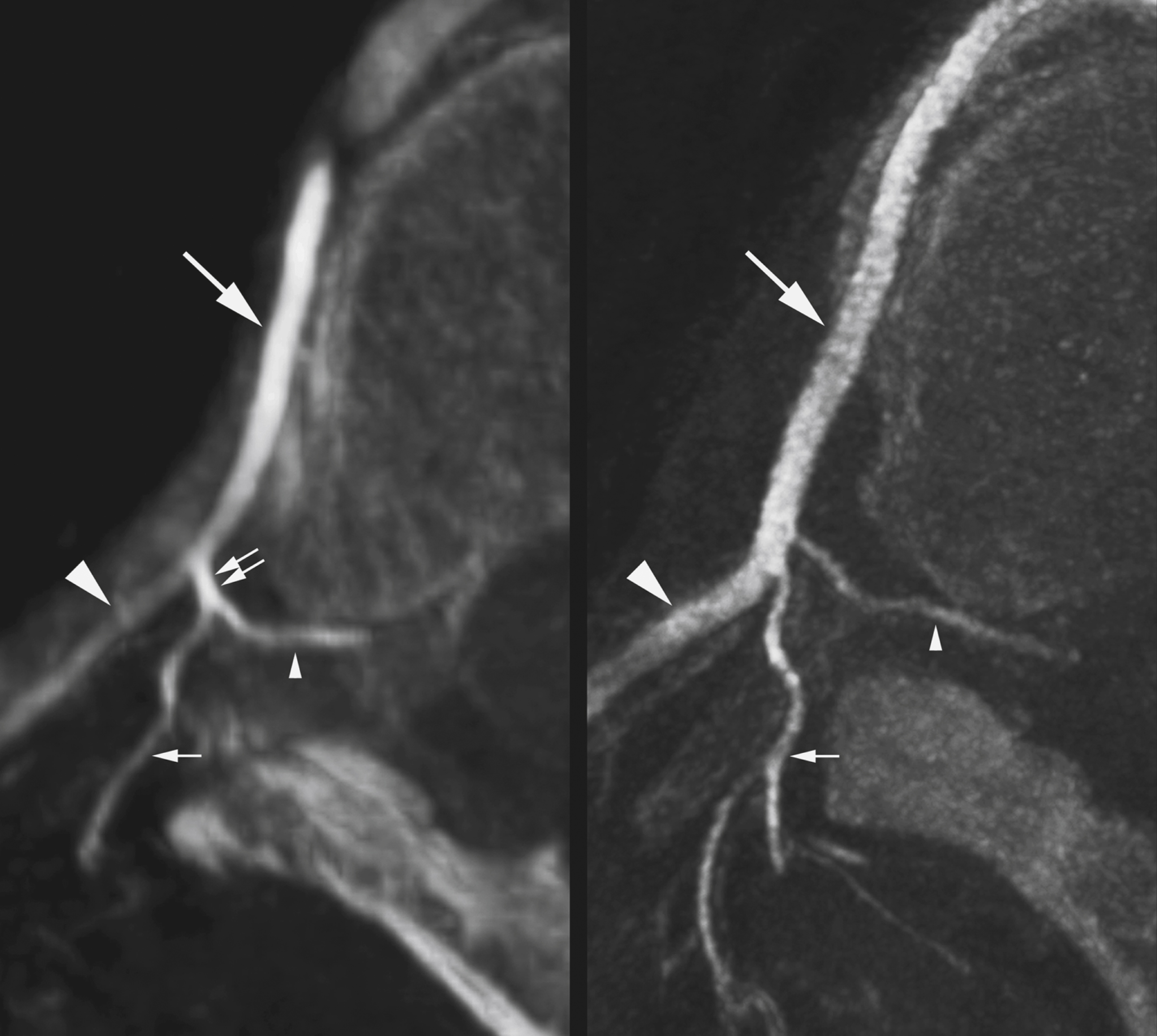 Fig. 57.2, Branching pattern of intersegmental arteries (ISAs) shown by flat-panel catheter angiotomography. Left side shows classic branching pattern, including aortic stem ( arrow ), lateral (or intercostal) branch ( arrowhead ), and dorsispinal artery (DA) ( double arrow ), with its spinal ( small arrowhead ) and dorsal ( small arrow ) components. On right, spinal and dorsal branches originate separately from intersegmental stem; there is therefore no DA. Fundamental constituents of ISA are aortic stem and its spinal branch. Lateral and dorsal musculocutaneous branches develop later.