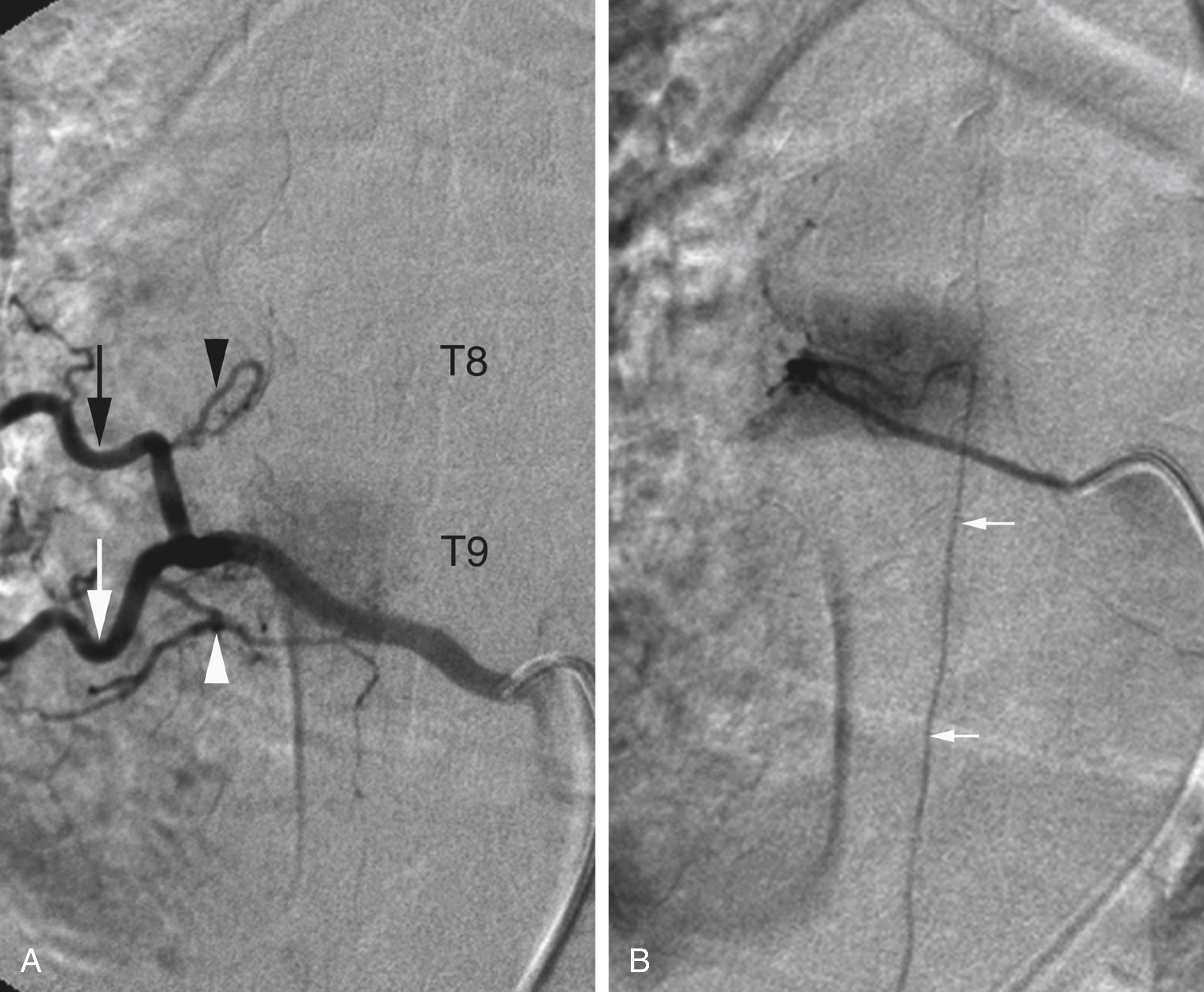 Fig. 57.21, Incomplete ipsilateral trunk with isolated spinal artery at right T8. (A) Ipsilateral trunk for right T9 and T8, which includes lateral branches for both T9 and T8 ( white and black arrows ) and a dorsispinal artery at T9 ( white arrowhead ) but only a dorsal branch at T8 ( black arrowhead ). Although this variant simulates a complete ipsilateral trunk, absence of a hemivertebral blush at T8 while one is clearly seen at T9 strongly suggests an incomplete type. (B) Injection of diminutive right T8 internal segmental artery (ISA) that only consists of stem with spinal branch, the latter providing artery of Adamkiewicz ( small arrows ). This configuration represents ISA in its simplest form, equivalent to embryonic ISA (see Fig. 57.1C ).