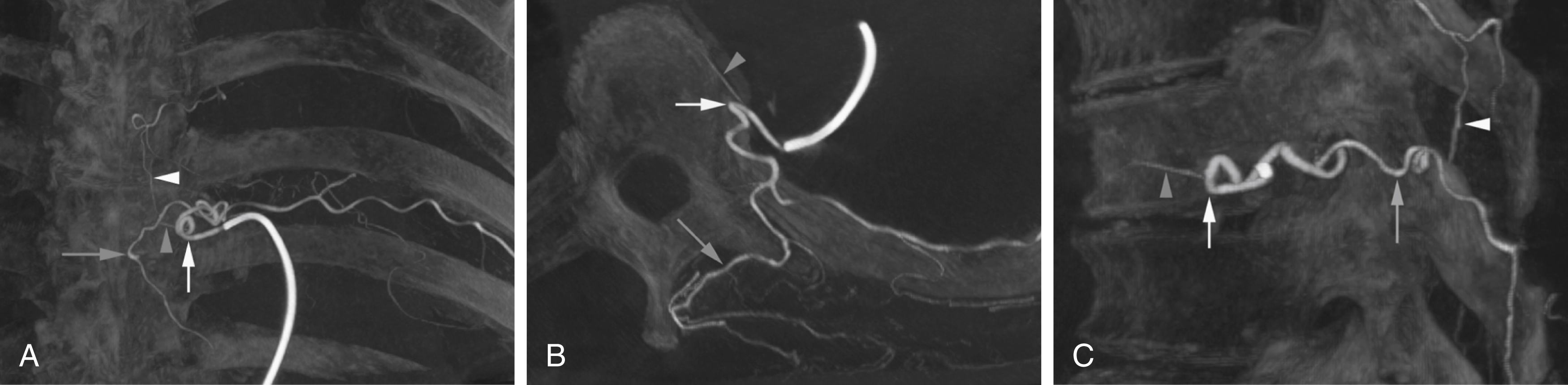 Fig. 57.3, Flat-panel catheter angiotomography of left T6 showing thoracic internal segmental artery (ISA) anatomy. Typical anatomy of left thoracic ISA in coronal (A), sagittal (B), and axial (C) planes. Two-dimensional nature of angiography results in superposition of many branches that can at times be difficult to distinguish (e.g., prominent dorsal muscular branch [ white arrowhead ] may adopt course reminiscent of spinal contributor). Because of leftward position of thoracic aorta, ISAs are longer on right side than on left, in particular at upper thoracic levels, where left ISAs adopt an initial recurrent course before curving sharply backward to pass behind mediastinal attachment of endothoracic fascia ( white arrow ). Recurrent osseous branch is stretched over lateral aspect of vertebral body ( gray arrowhead ). Gray arrow points at dorsal branch of ISA (or dorsal component of dorsispinal artery) as it divides into its terminal musculocutaneous branches.