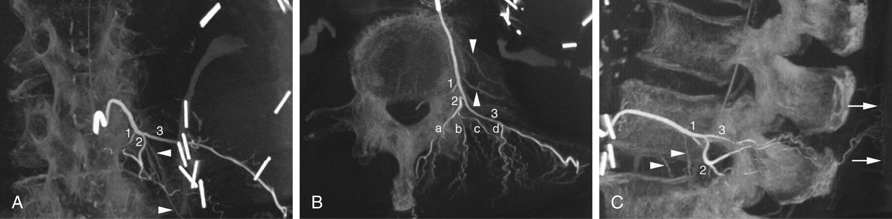 Fig. 57.4, Flat-panel catheter angiotomography of left L3 showing lumbar internal segmental artery (ISA) anatomy. Typical anatomy of left lumbar ISA in coronal (A), axial (B), and sagittal (C) planes. White arrowheads point at two prominent branches for psoas muscle (note muscular blush in [B]). White arrows in (C) indicate terminal subcutaneous arterial network. Note that spinal branch ( 1 ), which provides the artery of Adamkiewicz, arises from ISA trunk proximal to its bifurcation into dorsal ( 2 ) and lateral ( 3 ) branches. Medial ( a ), intermediate ( b ), and lateral ( c ) muscular branches of dorsal component of the ISA are shown in (B), as well as a posterior perforating artery ( d ) of lateral branch, which participates in vascularization of paravertebral musculature.