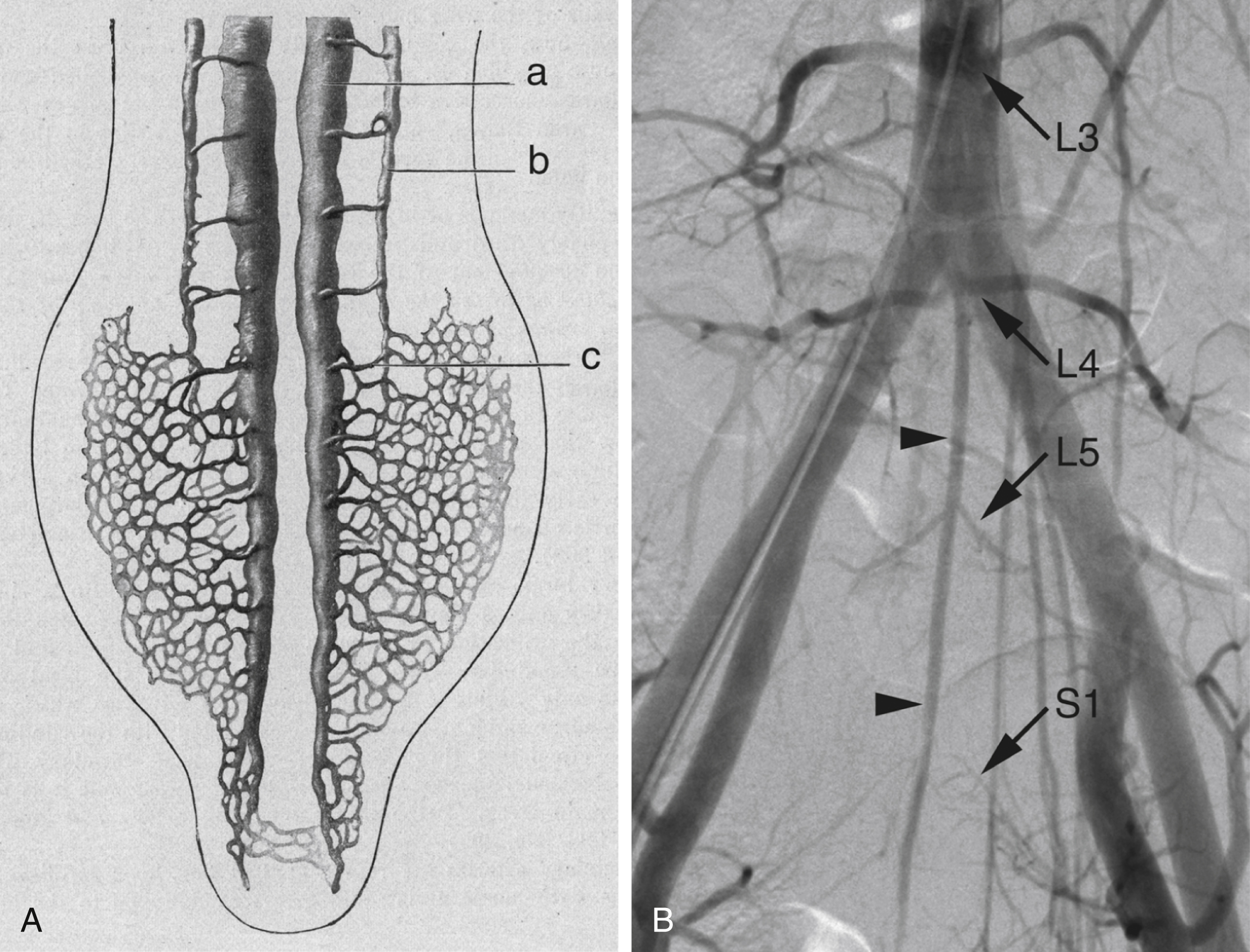 Fig. 57.5, Anatomy of internal segmental artery (ISA) at sacral level. (A) Posterior view of capillary network associated with early leg buds of a chick (network originates from lateral aortic branches rather than dorsal ones). 7 67 The portion of dorsal aortas distal to origin of iliac arteries will fuse into a single midline vessel, the median sacral artery (MSA). For convenience, original legends have been replaced with single letters: a , right dorsal aorta; b , right posterior cardinal vein; c , 27th dorsal intersegmental vessel. (B) Posteroanterior projection of a pelvic angiogram illustrates adult equivalent of structures shown in (A). Note that MSA ( arrowheads ) exhibits intersegmental pattern typical of primitive dorsal aortas, providing L4 ISAs completely, L5 ISAs partially, and connecting laterally with superior lateral sacral artery at S1.