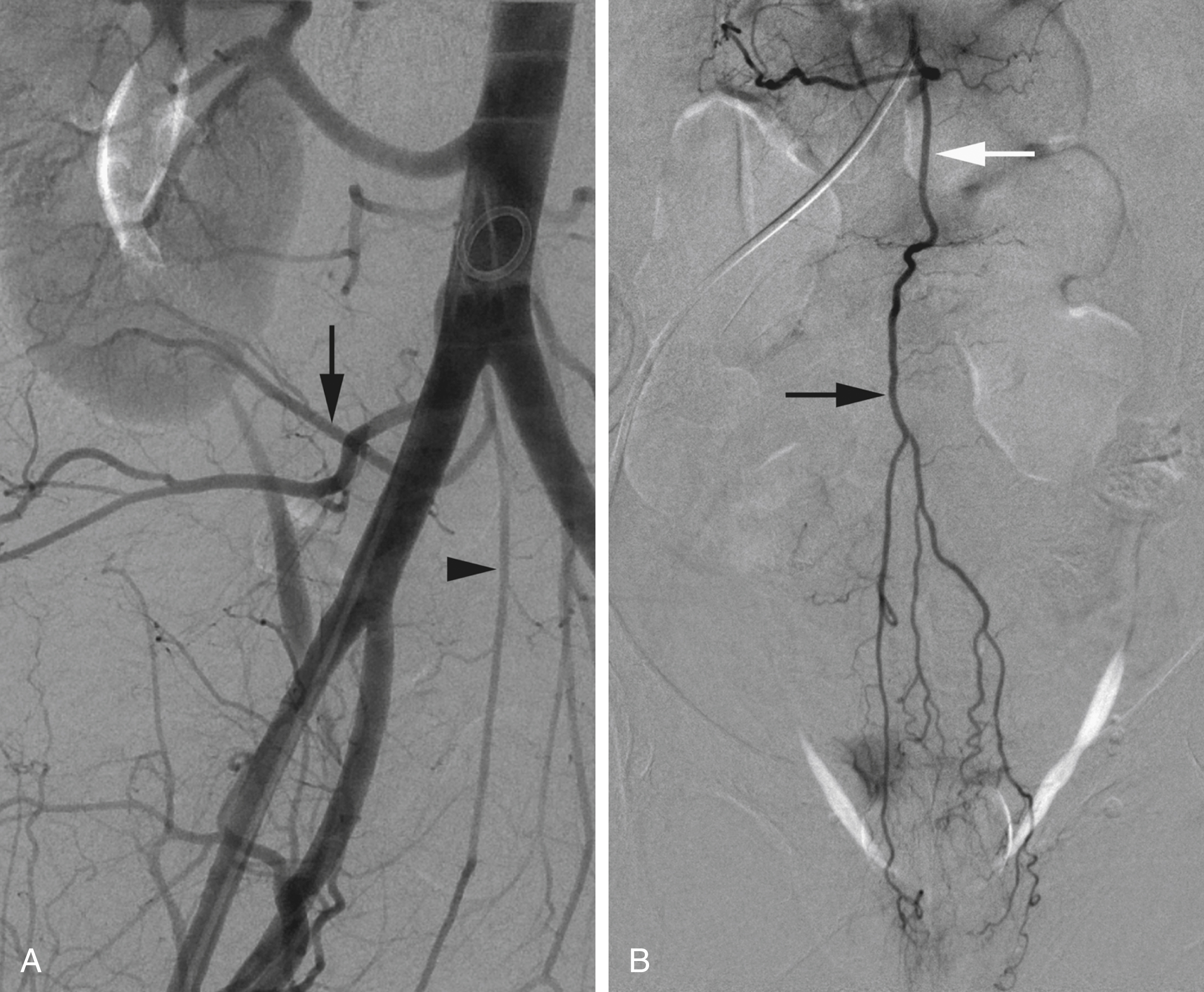 Fig. 57.6, Anomalous branches of median sacral artery (MSA). (A) An inferior polar artery ( arrow ) coming from MSA ( arrowhead ). (B) Superior rectal artery ( black arrow ) originates from MSA ( white arrow ). Although rare, these variants must be kept in mind when seeking elusive sources of hemorrhage from kidney or bowel.