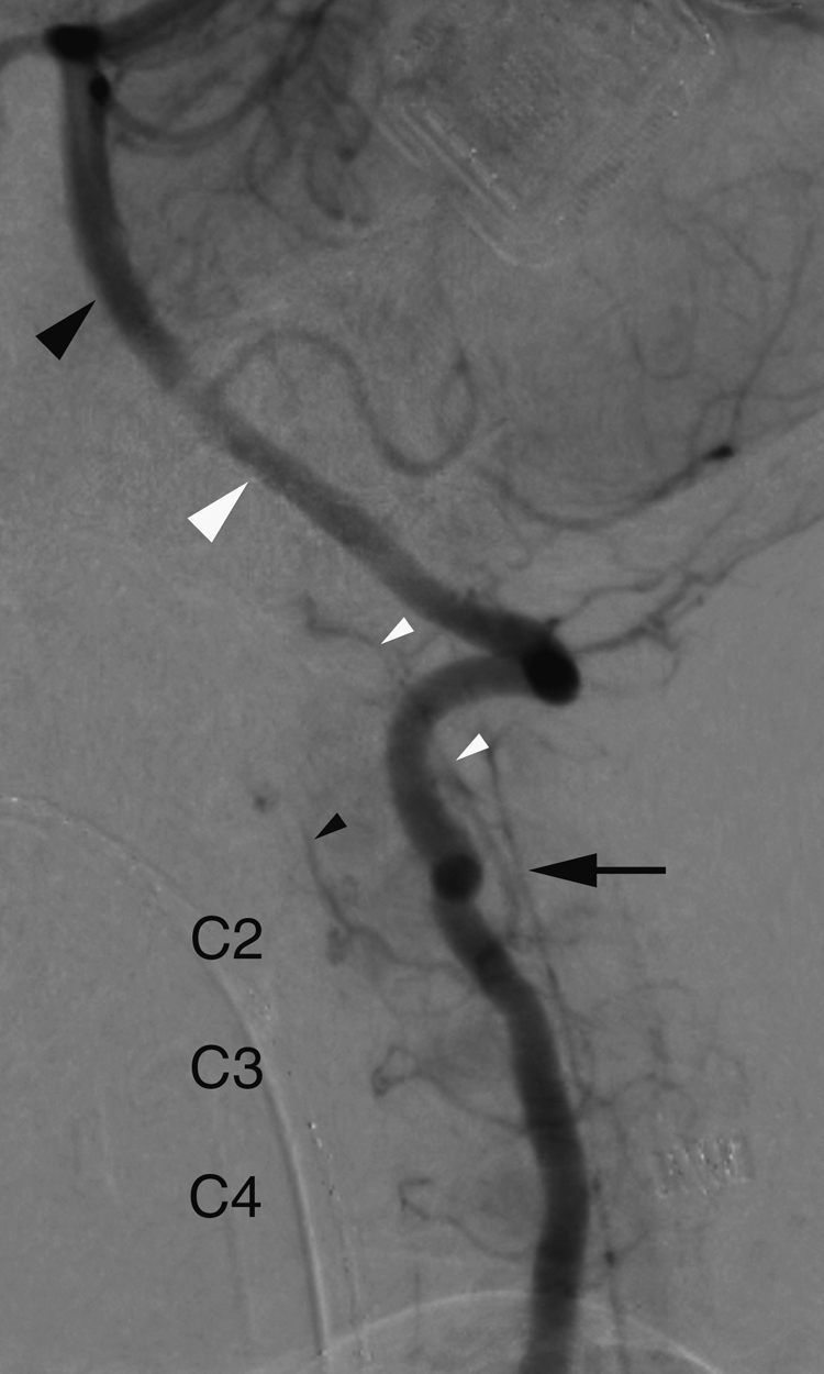 Fig. 57.7, Anatomy of internal segmental artery (ISA) at cervical level. In this vertebral artery (VA) injection, intersegmental anatomy remains apparent at C2, C3, and C4 (ISA 1-3). VA is made of a chain of longitudinal anastomoses, connecting caudally with subclavian artery and cranially with proatlantal artery. Residual portions of proatlantal artery constitute, among other things, V3 and V4 segments of VA. V4 segment corresponds to ascending ramus of anterior radicular branch of C1 ( large white arrowhead ). Basilar artery ( large black arrowhead ) is the fusion of primitive anterior spinal axes at brainstem level. Arrow points at anterior spinal artery (ASA), connected cranially to descending ramus of anterior radicular branch of C1 (V4 segment at adult stage). Note anterior ( small black arrowhead ) and posterior ( small white arrowheads ) ascending arteries, two branches of VA derived from first ISA that supply odontoid process.