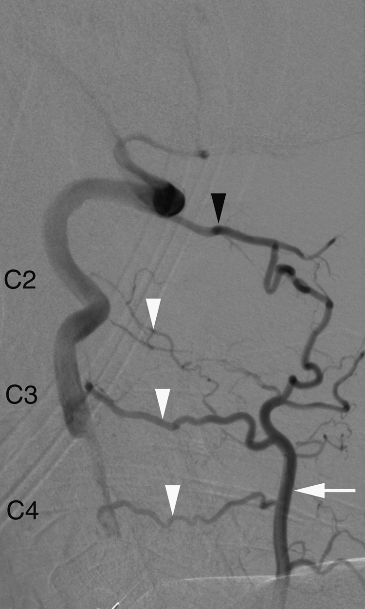 Fig. 57.8, Vertebral collateral supply via primitive internal segmental arteries (ISAs). Original intersegmental pattern is not always apparent at adult stage, but inconspicuous primitive vessels remain patent and can play important roles later in life. In this patient with proximal left vertebral artery occlusion, collateral supply is provided by left deep cervical artery ( white arrow ) via dorsal branches of proatlantal artery ( black arrowhead ) and first three ISAs ( white arrowheads ).