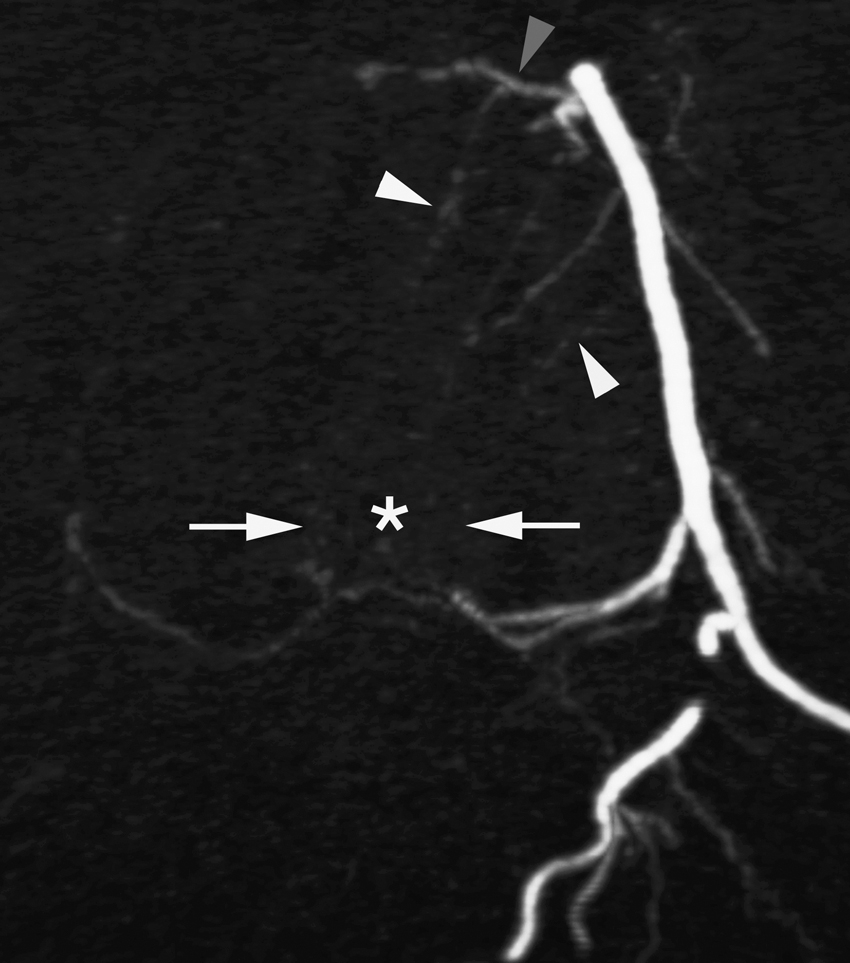 Fig. 57.9, Arteries of vertebral body. Subtracted axial reconstruction of three-dimensional digital subtraction angiography acquisition of left L3 documents two main groups of branches vascularizing vertebral body: anterolateral ( white arrowheads ) and posteromedian ( white arrows ) osseous arteries. Posteromedian arteries are branches of retrocorporeal artery that penetrate posterior wall of vertebral body through basivertebral foramen ( asterisk ). Gray arrowhead points at recurrent osseous branch, splayed over anterior wall of vertebra.