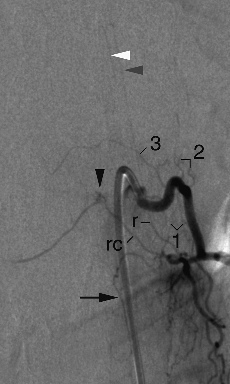 Fig. 57.10, Angiographic appearance of osseous arteries. Posteroanterior projection of a left T9 angiogram shows inferior ( 1 ), superior ( 2 ), and recurrent ( 3 ) osseous branches of internal segmental artery, as well as retrocorporeal artery ( rc ) and its tufts of posteromedian branches entering basivertebral foramen ( black arrowhead ). Black arrow points at a paramedian dorsal musculocutaneous branch; r refers to radicular artery of T9, which provides both anterior ( white arrowhead ) and posterior ( gray arrowhead ) spinal contributors.
