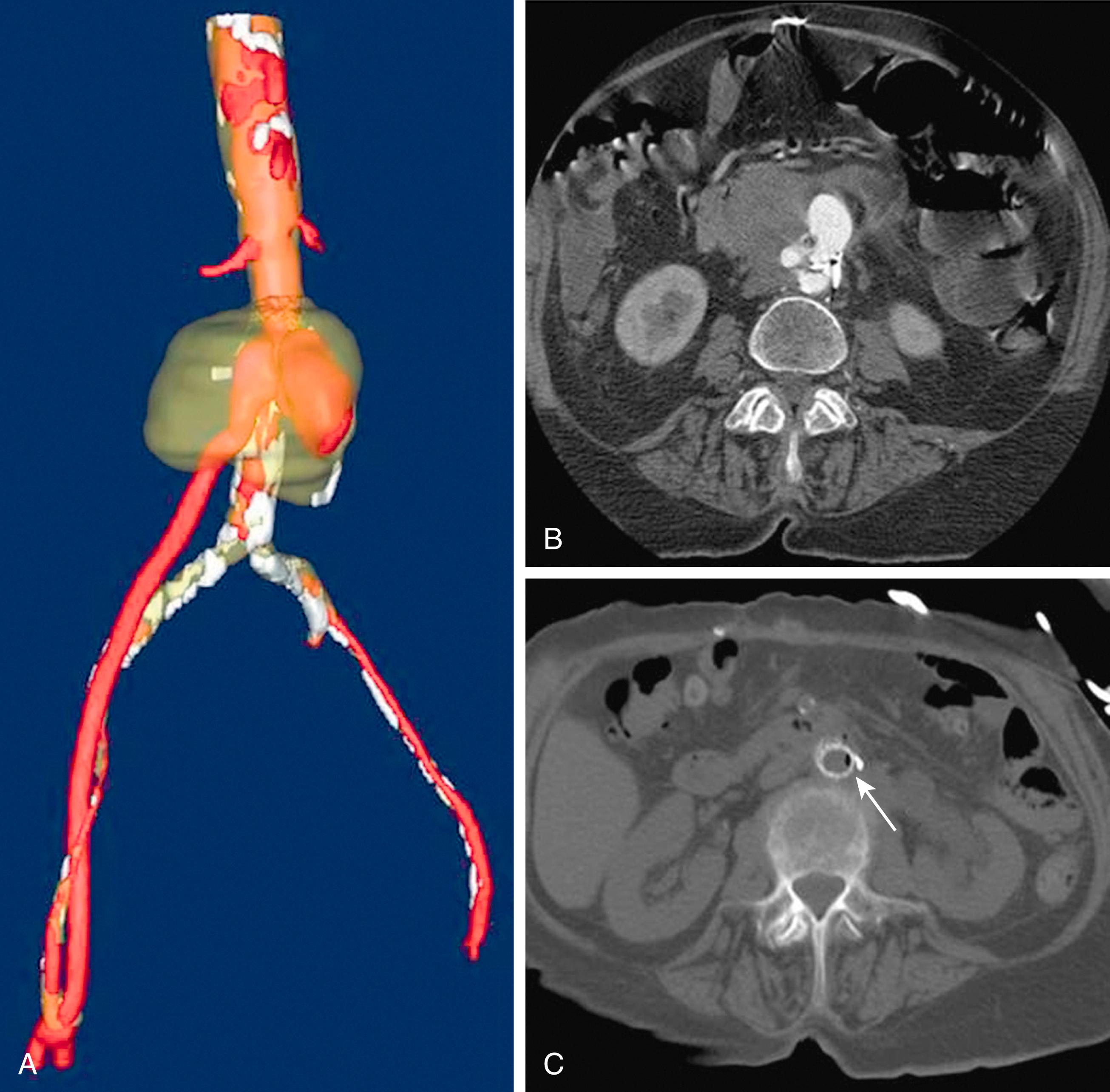 Figure 71.2, Three-dimensional reconstruction (A) and axial computed tomography imaging (B, C) of a proximal infected anastomotic pseudoaneurysm in an aortofemoral bypass graft. Arrow shows gas formed by infecting bacteria.