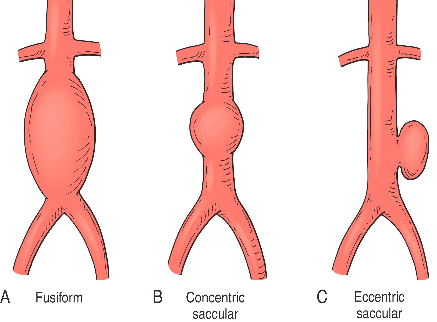 Figure 71.3, ( A ) Fusiform; ( B ) concentric saccular; and ( C ) eccentric saccular aneurysm morphology.