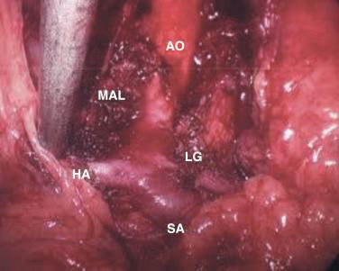 FIGURE 77-1, Median arcuate ligament (MAL). AO , Aorta; HA , hepatic artery; LG , left gastric; SA , splenic artery.