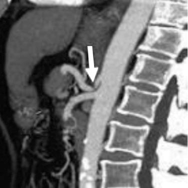 FIGURE 77-2, Median arcuate ligament causing narrowing of the celiac trunk (arrow) .