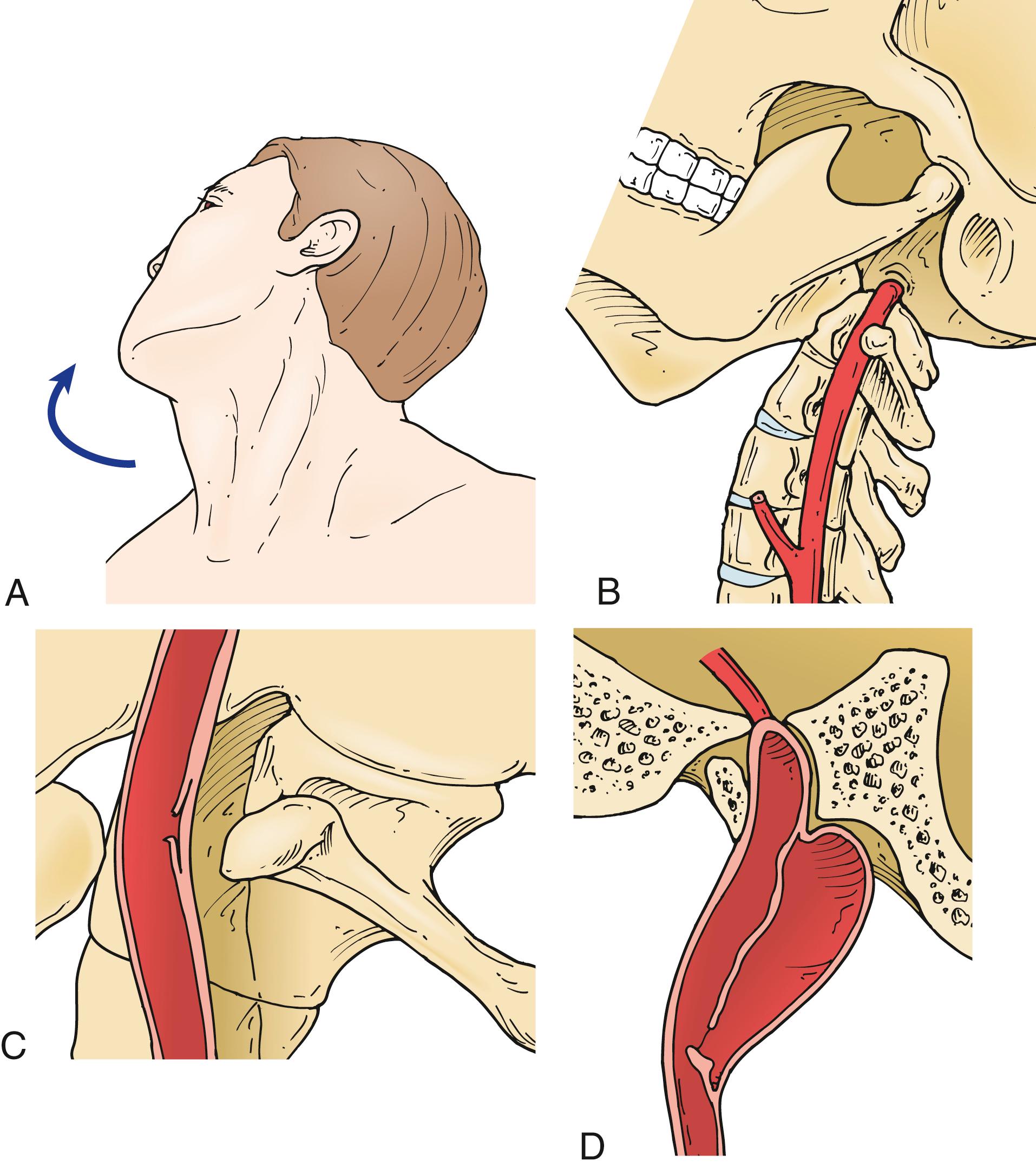 Fig. 35.2, Presumed mechanism of carotid injury induced by neck rotation. (A) Direction of hyperextension. (B) Impingement of artery on the process of the vertebra. (C) Intimal tear caused by impingement. (D) Progression of intimal tear to dissection.