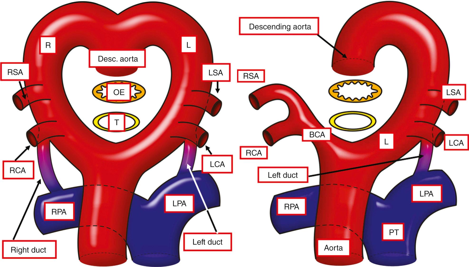 Fig. 41.1, Left, Primitive system of double arches proposed by Edwards to explain vascular rings and slings. The arches persist on both the right (R) and left (L) sides, uniting posteriorly to form a neutral descending (desc.) aorta. Each arch gives rise to subclavian and common carotid (CA) arteries, along with an arterial duct, which joins the appropriate pulmonary artery. The aortic sac and outflow tract have divided to form the aorta and the pulmonary trunk (PT). The double arch surrounds the tracheoesophageal pedicle (OE,T). Right, With normal development, the right arch and right duct regress, leaving a left arch feeding the descending aorta, an arterial duct on the left side, with the brachiocephalic artery (BCA) giving rise to the right common carotid and subclavian arteries. LCA, Left carotid artery; LPA, left pulmonary artery; LSA, left subclavian artery; RCA, right carotid artery; RPA, right pulmonary artery; RSA, right subclavian artery.