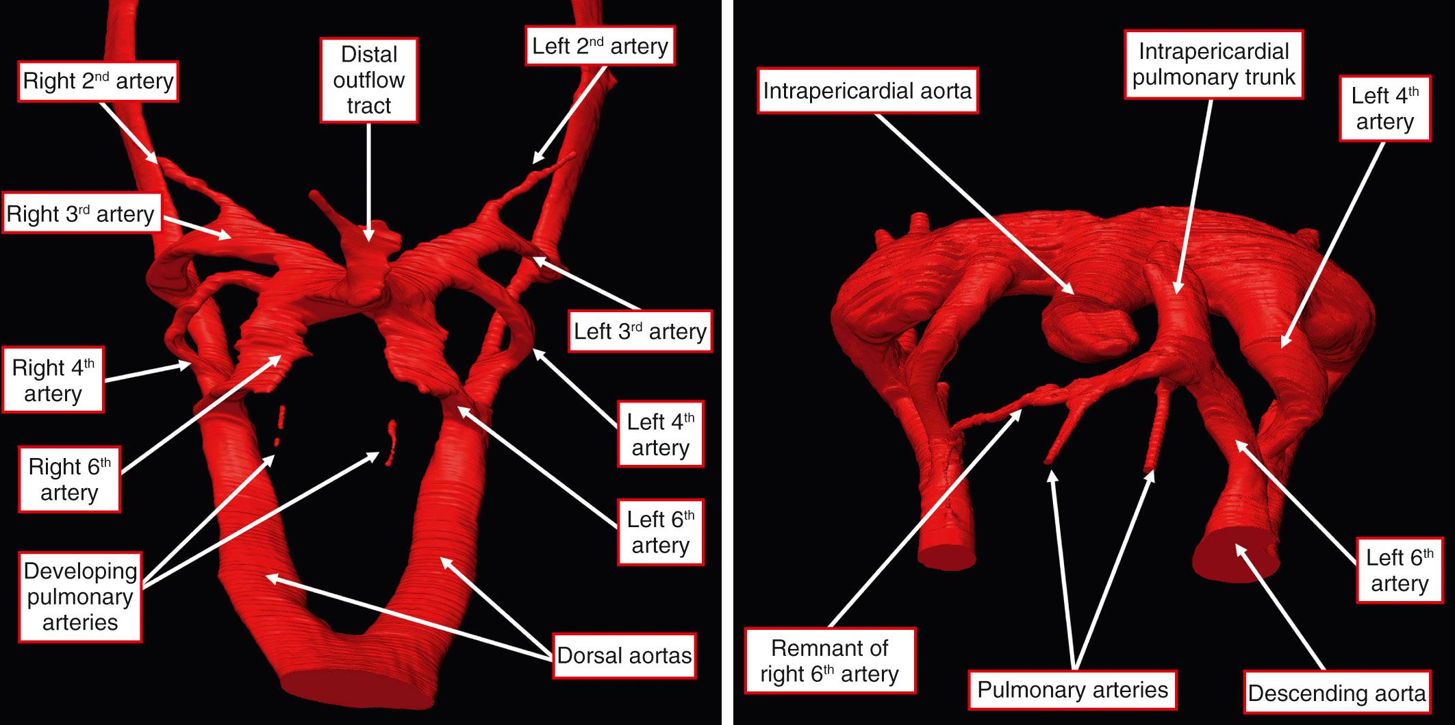 Fig. 41.2, Reconstruction of the developing arteries of the pharyngeal arches in embryonic mice sacrificed during the 11th (left) and 12th (right) days of development. The reconstructions are viewed from the front, with right-sided structures seen to the left. At the early stage, the arteries of the second arch are beginning to regress, with the arteries of the third, fourth, and sixth arches formed in symmetric fashion. The cavity of the distal outflow tract is a common structure at this stage. The pulmonary arteries are beginning to develop within the ventral component of the pharyngeal mesenchyme. By the 12th day, the right sixth arch artery is beginning to regress. The distal outflow tract has now separated into the intrapericardial components of the aorta and pulmonary trunk. The pulmonary arteries now arise from the pulmonary trunk, with the left sixth arch artery forming the arterial duct. The right dorsal aorta is still present but is now significantly smaller that the left component, which will become the descending aorta as the right side continues to regress.